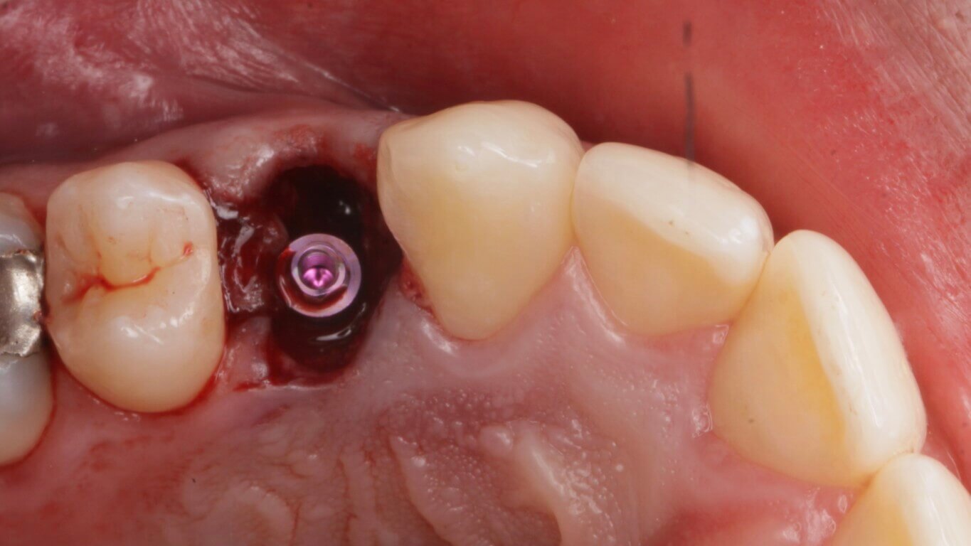 After - Full Arch Surgery with Dr. Khartic Patel