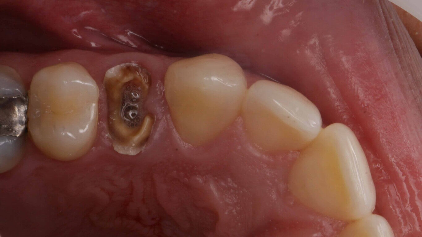 Gallery image for Full Arch Surgery with Dr. Khartic Patel