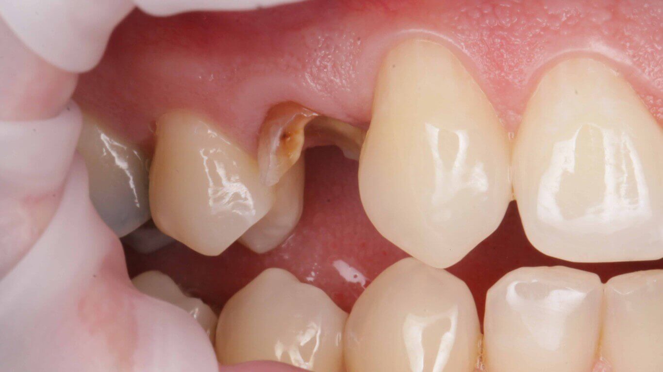 Gallery image for Full Arch Surgery with Dr. Khartic Patel