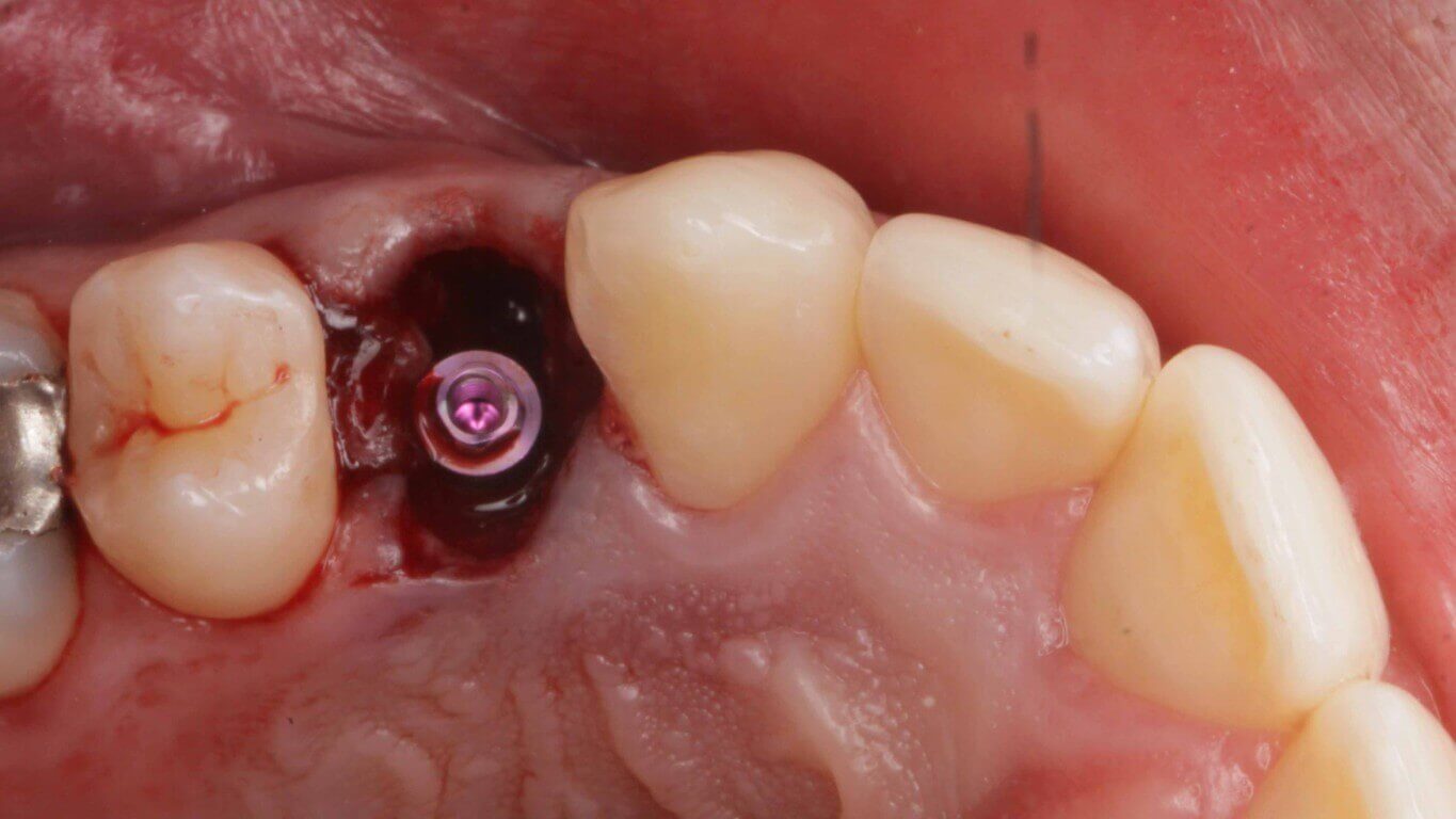 Gallery image for Full Arch Surgery with Dr. Khartic Patel