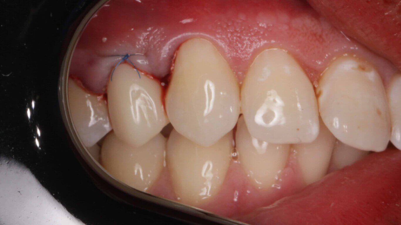 Gallery image for Full Arch Surgery with Dr. Khartic Patel