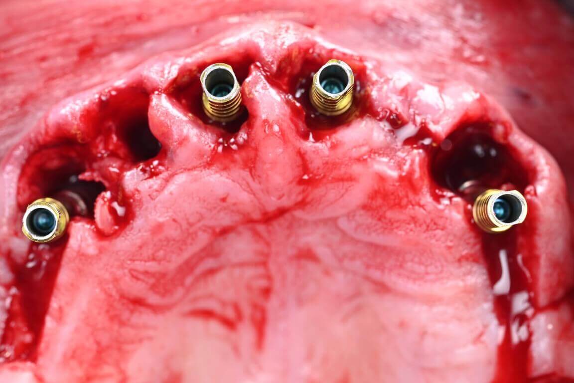 After - Full Arch Surgery with Dr. Shubhan Mittal