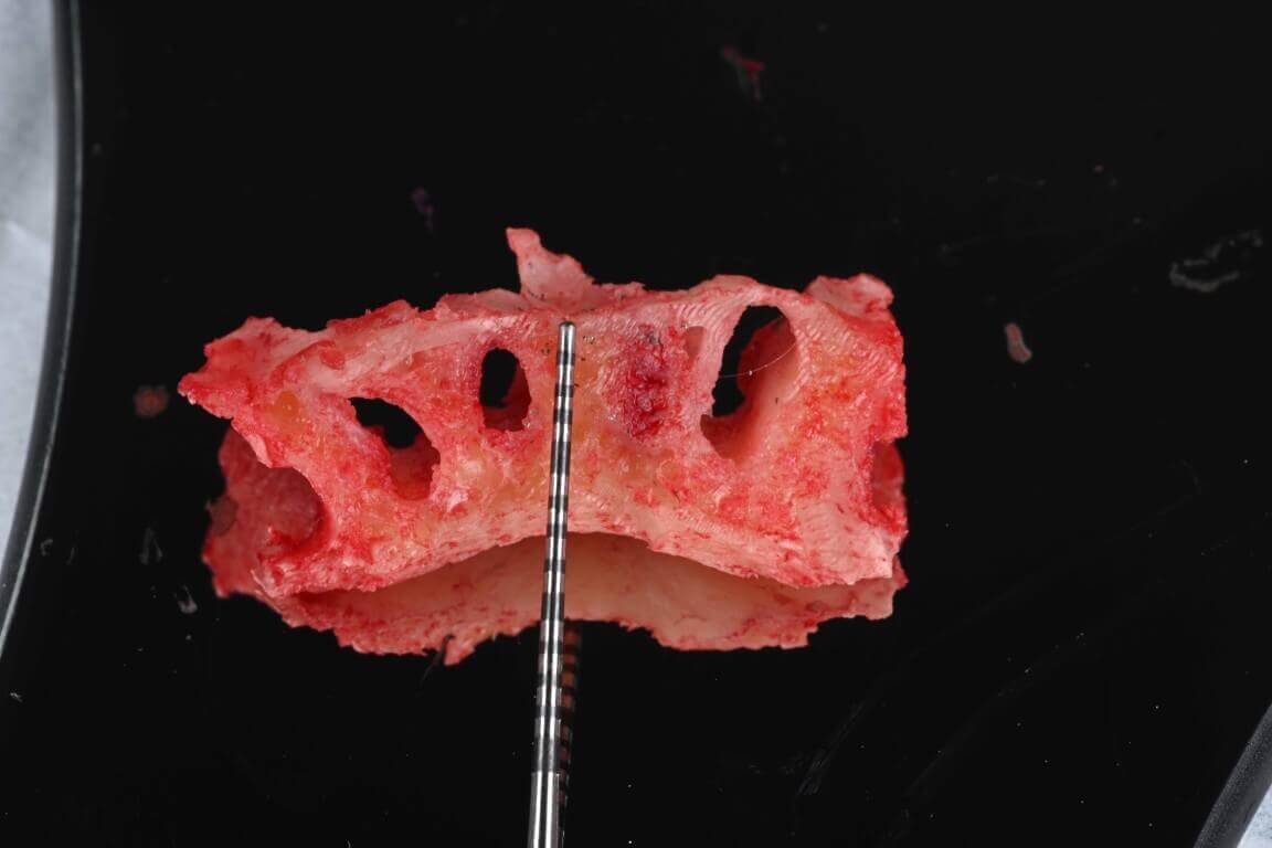 Additional media for Full Arch Surgery with Dr. Shubhan Mittal