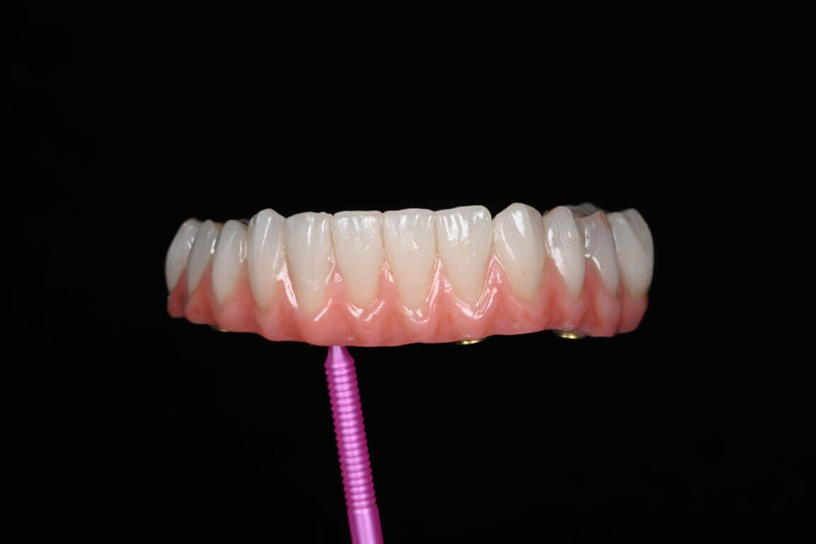 Additional media for Full Arch Surgery with Dr. Shubhan Mittal