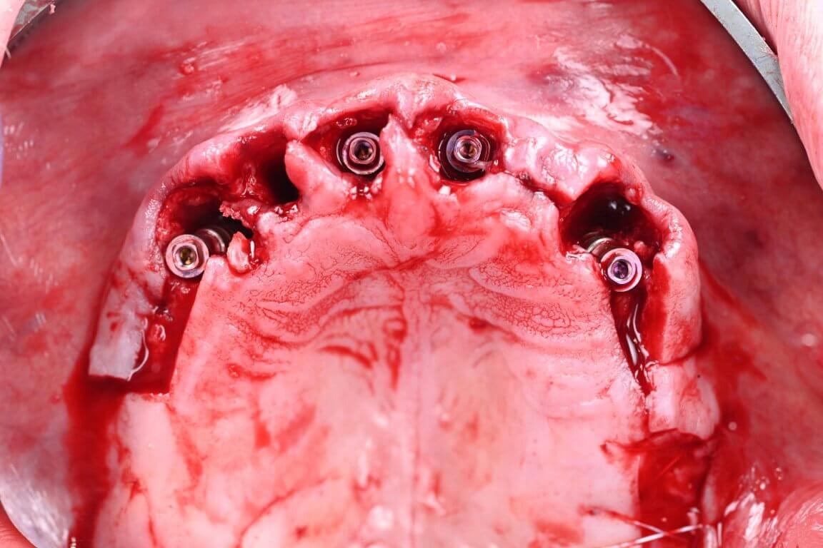 Gallery image for Full Arch Surgery with Dr. Shubhan Mittal