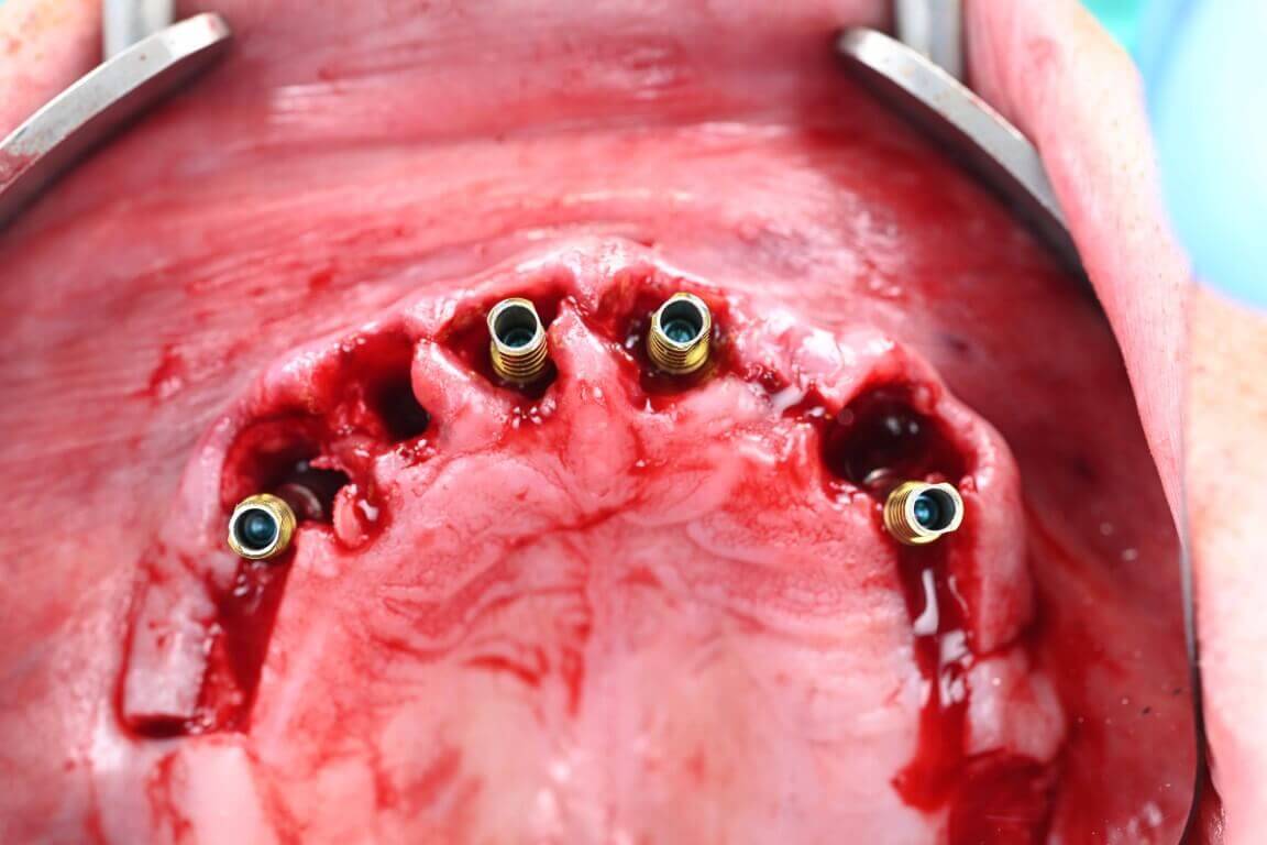 Gallery image for Full Arch Surgery with Dr. Shubhan Mittal