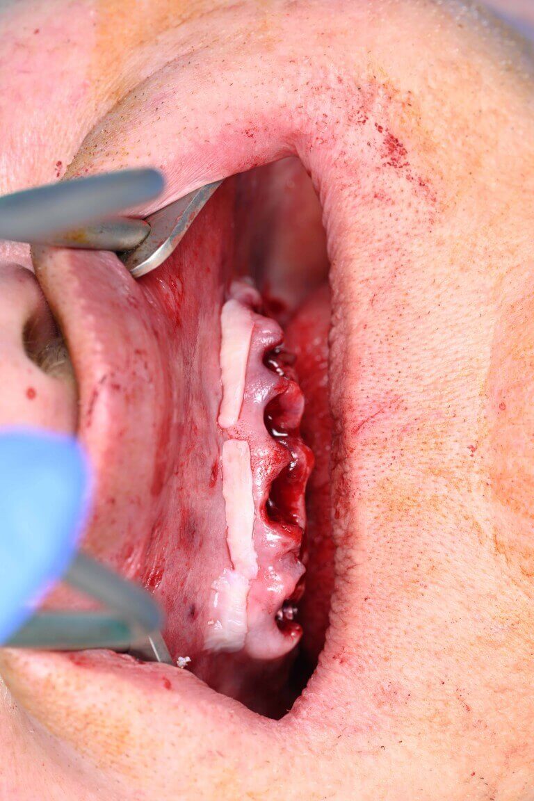 Gallery image for Full Arch Surgery with Dr. Shubhan Mittal