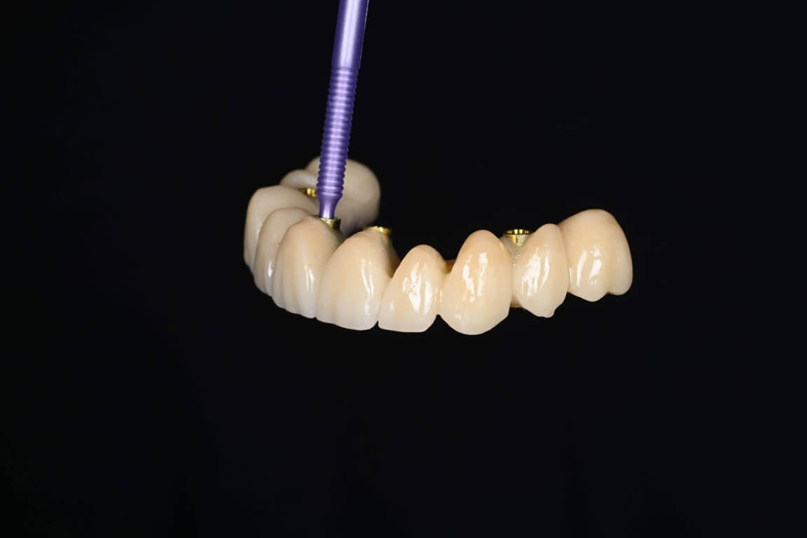 Gallery image for Full Arch Surgery with Dr. Shubhan Mittal