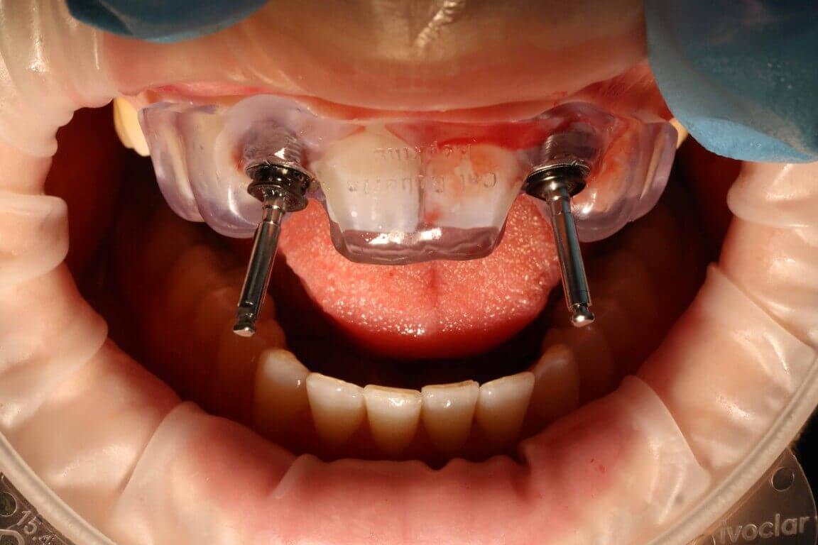 Gallery image for Profilo Guided Surgery with Dr. Simon Chard