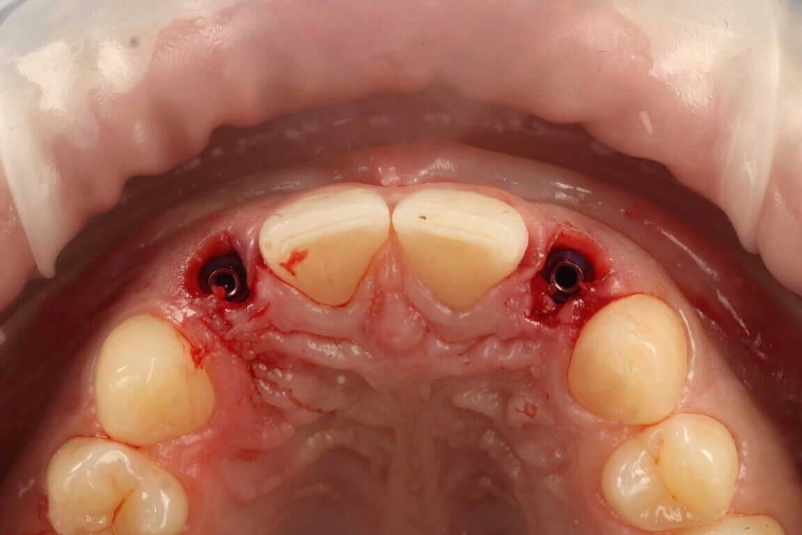 Gallery image for Profilo Guided Surgery with Dr. Simon Chard